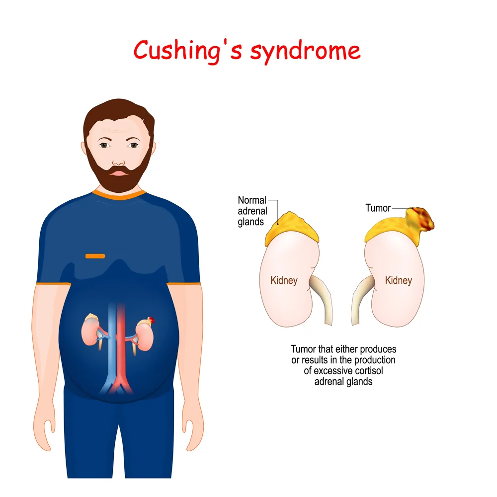 Cushing syndrome High Cortisol Etobicoke Naturopath