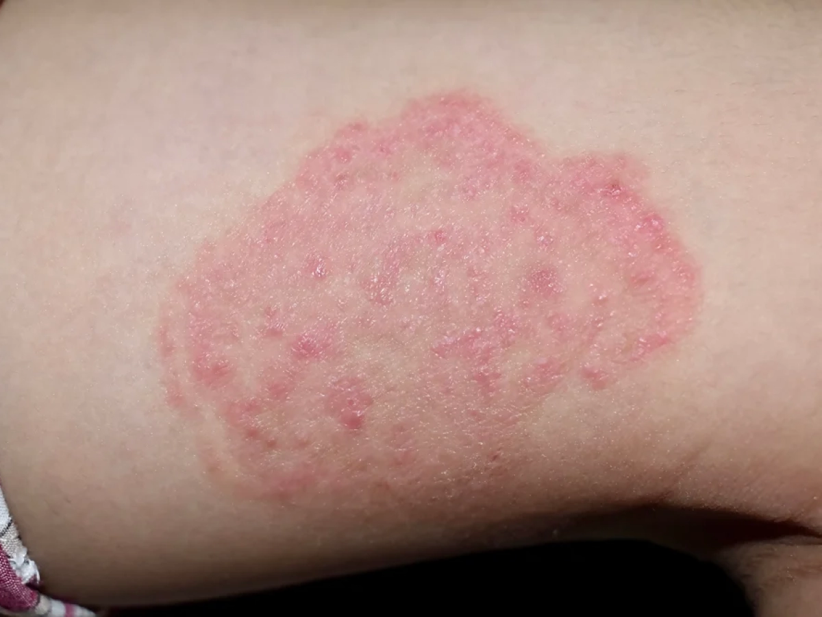 I posted 5 days ago when this was one spot. Someone said Tinea